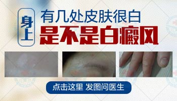 白癜风治疗