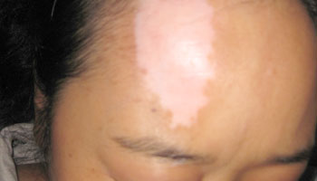 引起面部白斑发病的主要原因是什么
