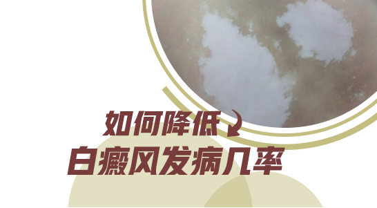 白癜风的忌口食物都在这里