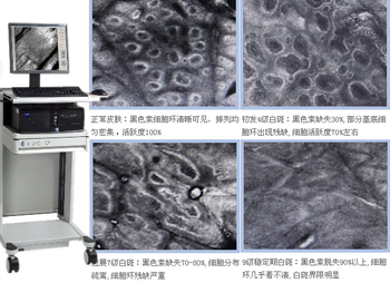 身上有白斑 五一做个白斑检查 查一次全明白