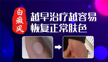 皮肤上有白点咋回事应该怎么治疗好